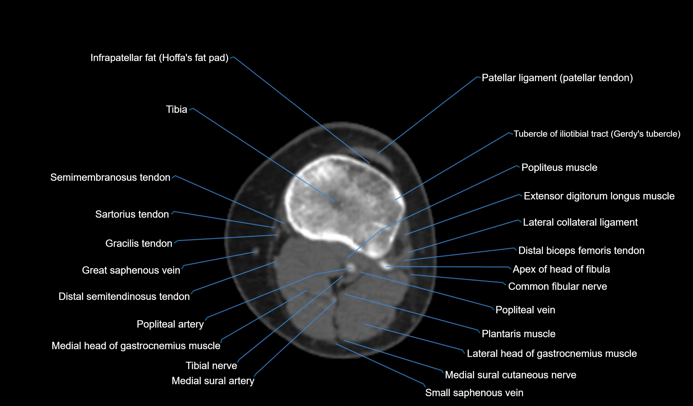 CT knee axial cross sectional anatomy labelled image-00042.webp